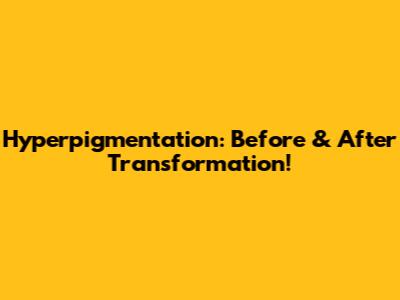 Hyperpigmentation: Before & After Transformation!